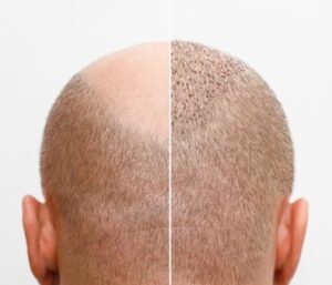 Solutions après une greffe de cheveux ratée