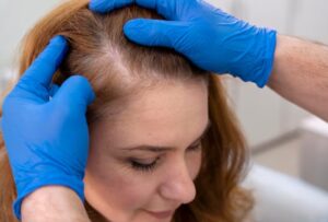 Greffe de cheveux avec un effet naturel : qu'est-ce qui détermine le succès ?