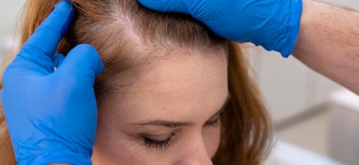 Greffe de cheveux avec un effet naturel : qu'est-ce qui détermine le succès ?