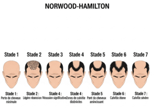 Diagramme de l'échelle de Norwood-Hamilton, un outil de référence utilisé par les chirurgiens pour estimer le nombre de greffons nécessaires