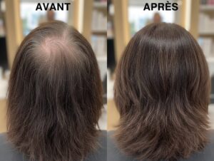 Photo comparative (deux panneaux) illustrant une amélioration spectaculaire de la densité du cuir chevelu chez une femme après greffe.