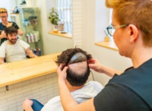 Pourquoi le marché de la greffe de cheveux est-il en pleine croissance ? 5 raisons de son succès