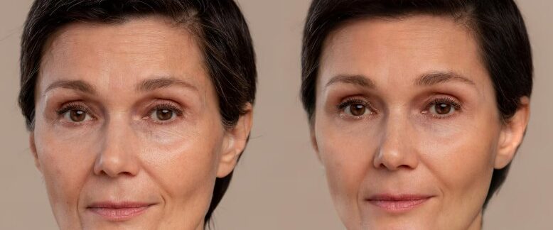Effet rajeunissant : comparaison du visage avant/après la greffe