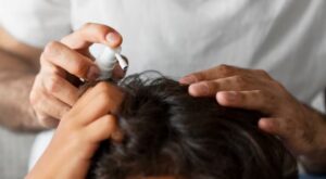 Le rôle des compléments dans la préparation à une greffe de cheveux
