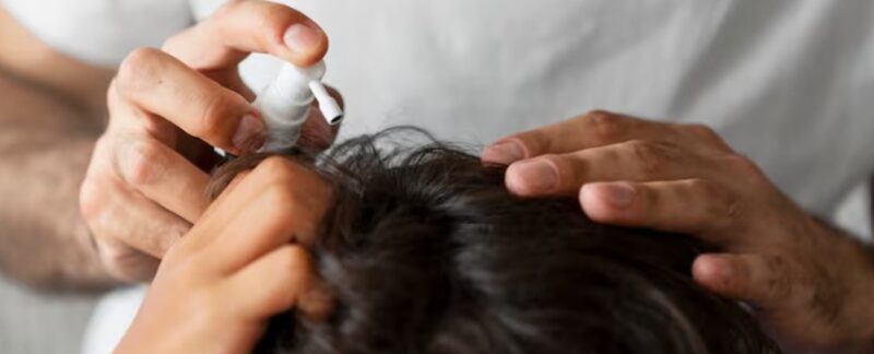 Le rôle des compléments dans la préparation à une greffe de cheveux