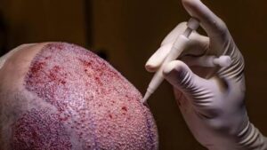 Quelle technique convient le mieux aux zones difficiles comme la couronne
