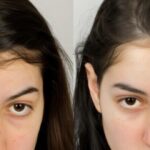 « Look naturel » : avant/après sans traces visibles de greffe