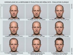 Chronologie de la repousse et évolution des résultats