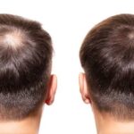 Double session de greffe de cheveux : résultats cumulatifs avant/après