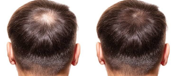 Double session de greffe de cheveux : résultats cumulatifs avant/après