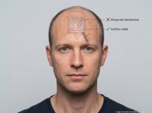 Exemple de greffon avec risque de transsection