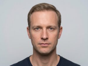 Densité capillaire restaurée sur l'ensemble du cuir chevelu après une double session de greffe de cheveux.