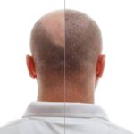 Comment annoncer à ses proches sa décision de greffe de cheveux