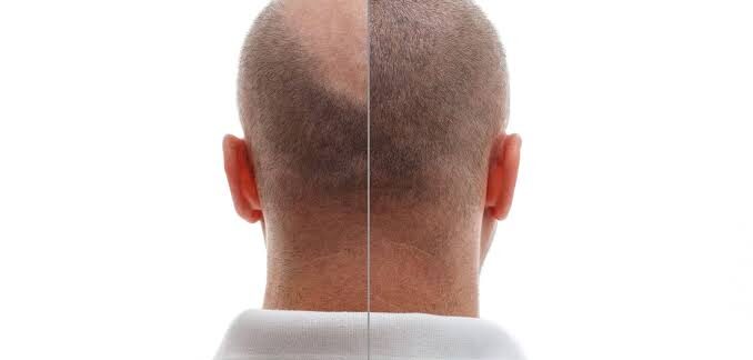 Comment annoncer à ses proches sa décision de greffe de cheveux