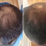Greffe de cheveux à partir de cellules souches