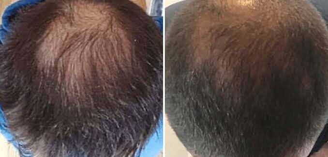 Greffe de cheveux à partir de cellules souches
