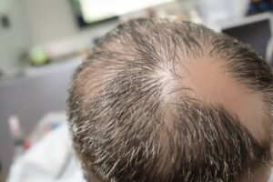 Greffe de cheveux à partir de cellules souches : état actuel de la recherche et perspectives d'avenir