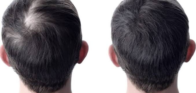 Greffe de cheveux et PRP : combiner les traitements pour de meilleurs résultats