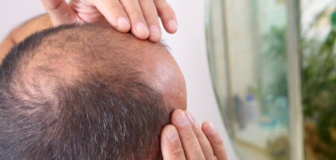 Pourquoi certaines greffes échouent-elles ? Erreurs courantes à éviter. Échecs des greffes de cheveux