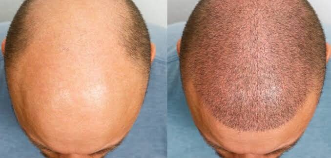 Quel est le juste prix pour une greffe de cheveux de qualité