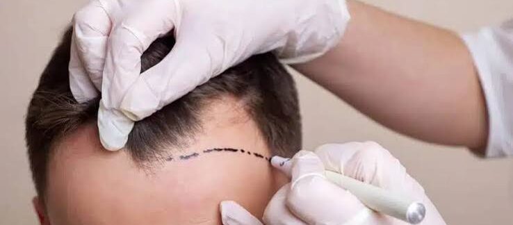 Traitements anticoagulants : précautions avant une greffe de cheveux